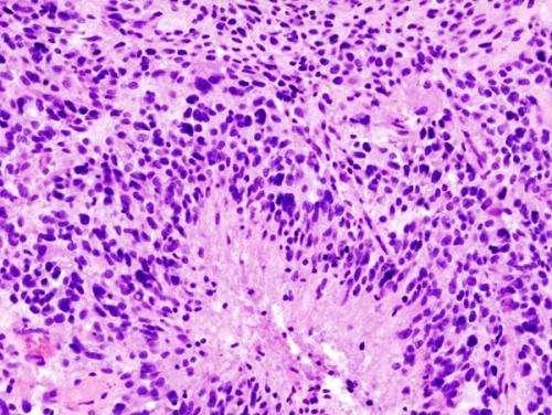 新疗法组合抑制多形性胶质母细胞瘤肿瘤生长