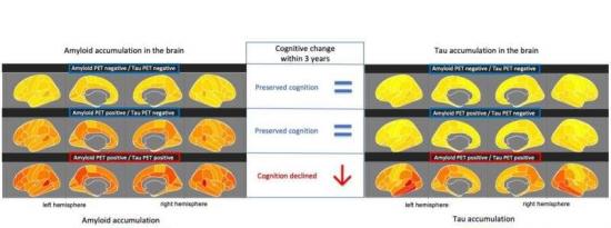 tau在大脑中的早期积累可预测阿尔茨海默病的记忆力下降