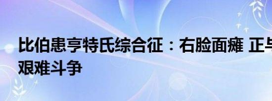 比伯患亨特氏综合征：右脸面瘫 正与面瘫做艰难斗争
