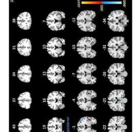 神经影像学研究揭示了治疗后莱姆病患者的功能性和结构性大脑异常