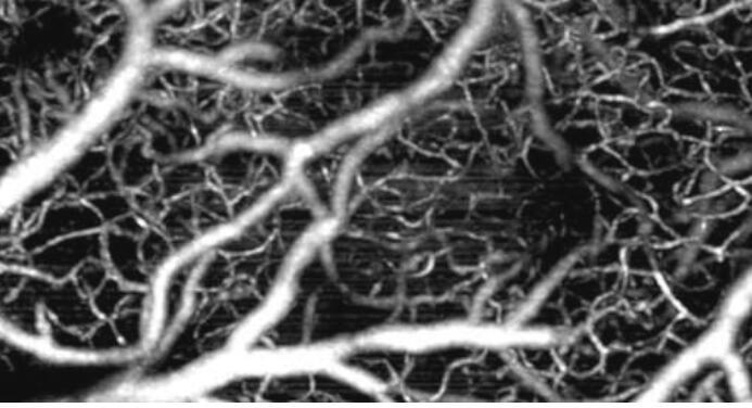 跟踪血管变化的新方法可以推进脑部疾病的检测