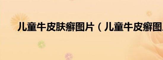 儿童牛皮肤癣图片（儿童牛皮癣图片）